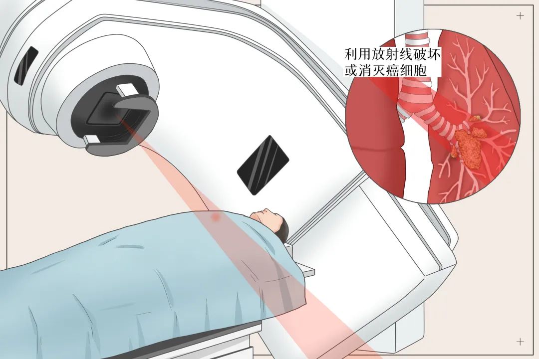 【高新轉載】放療適用于哪些腫瘤？