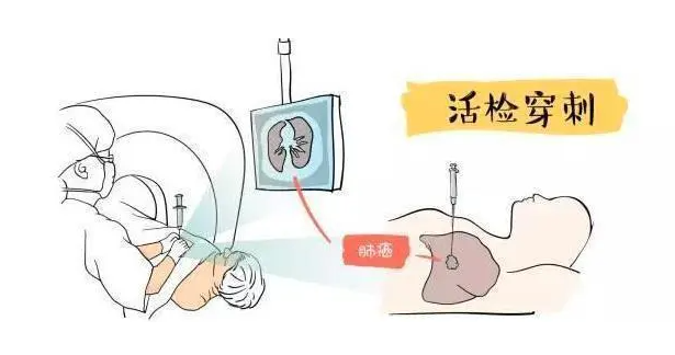 穿刺活檢是否會(huì)引起腫瘤細(xì)胞的擴(kuò)散轉(zhuǎn)移？