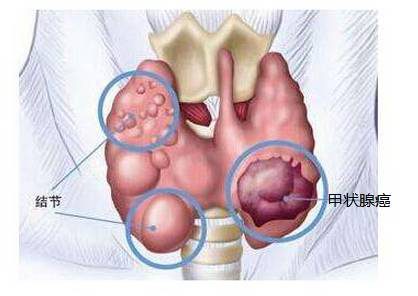 甲狀腺癌為何偏愛(ài)年輕人