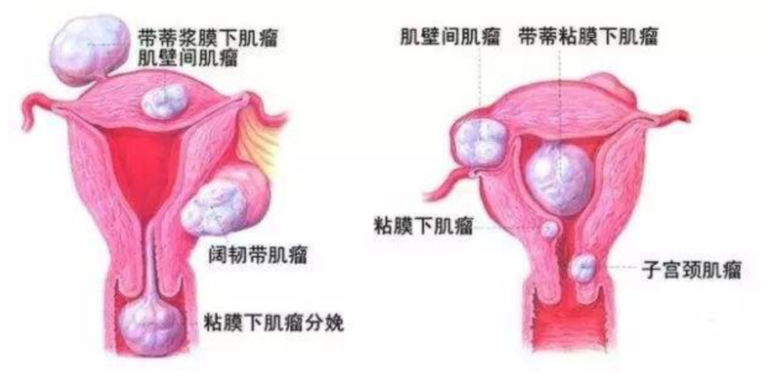 子宮肌瘤不開刀的治療方式——子宮動脈栓塞術(shù)