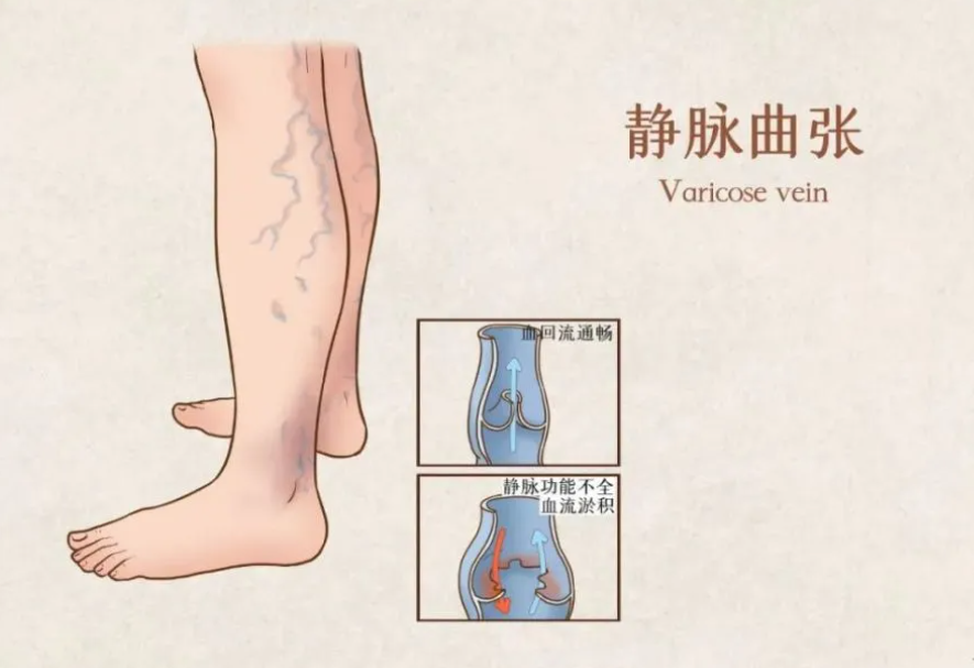 靜脈曲張不用開刀，介入治療也能輕松處理