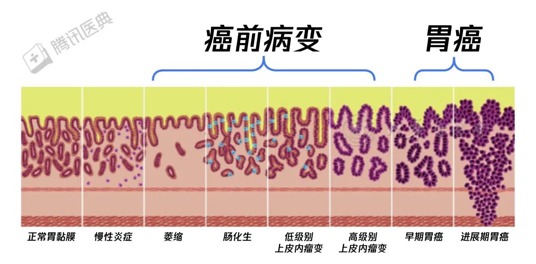 胃癌來臨前，會經(jīng)歷這個階段！千萬別不當回事